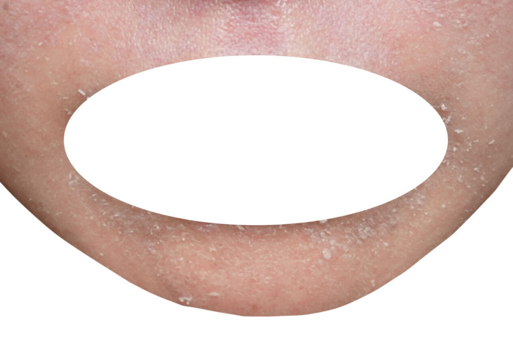 2073日焼け 顔 かゆい 処理